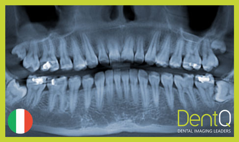 Inclusion Of Third Molars