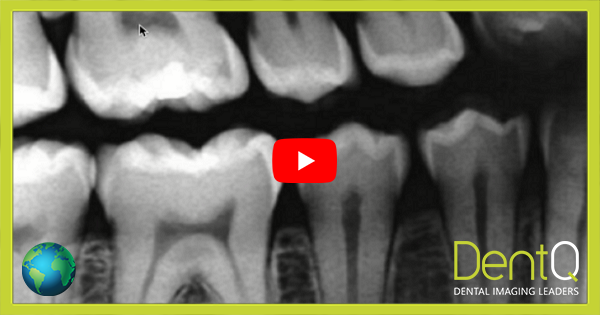 How to Read Dental X-ray - OPG and CBCT?