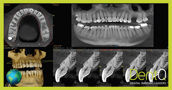 CBCT scan (Cone Beam Computed Tomography exam)