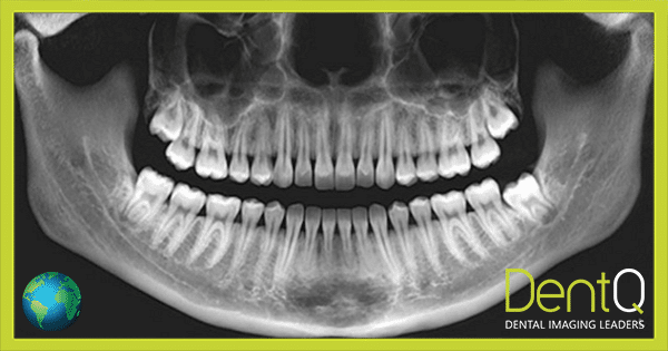 OPG scan (panoramic dental x ray)