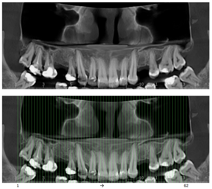 Implantation site (maxillary) | Slice step 2 mm