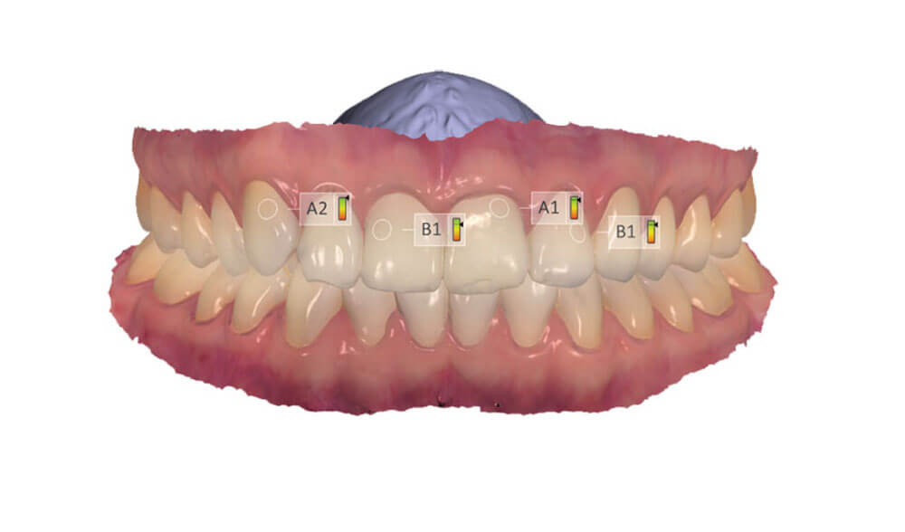 Intra Oral Scans (3D)