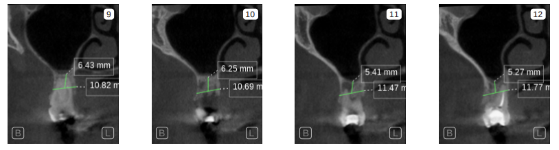Maxillary sections with measurements